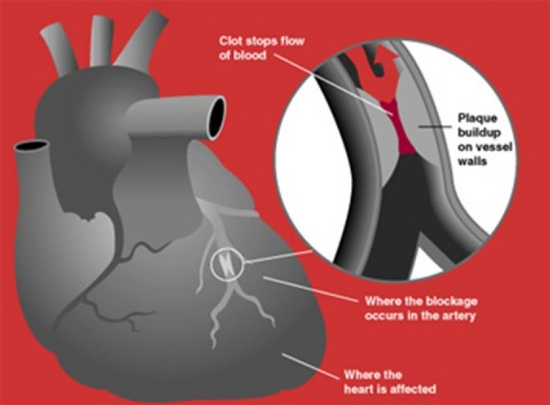 10 Things that Reduce Chances of Heart Stroke