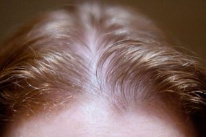 How to Fix Hair Thinning And Hair Fall