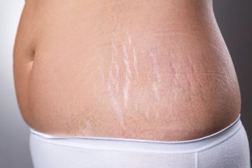 How to Reduce or Remove Stretch Marks