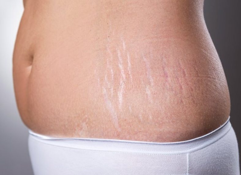 How to Reduce or Remove Stretch Marks